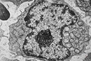 F,51y. | blood - chronic lymphatic leukemia … prolymphocyte